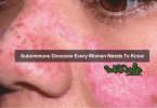 Autoimmune Diseases Every Woman Needs To Know 1