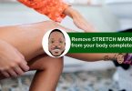 removing stretch marks completely